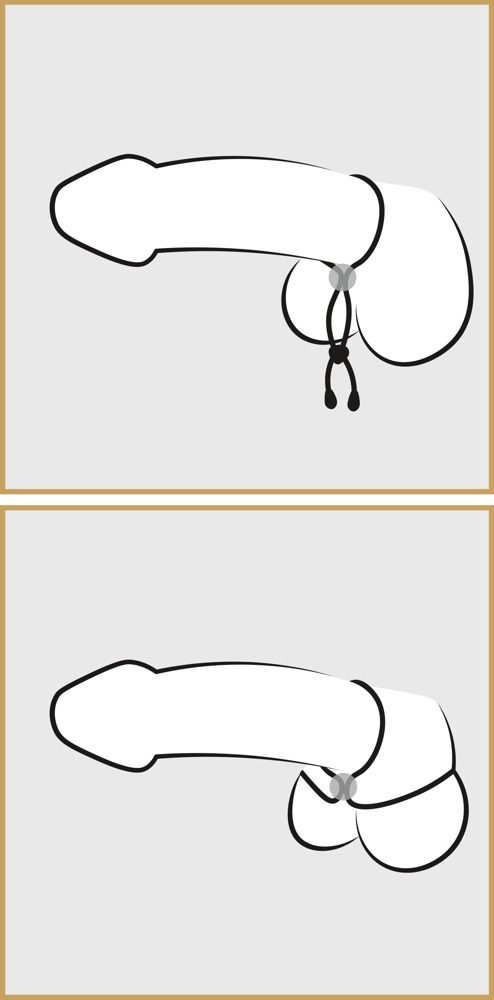 Zwei schematische Darstellungen einer Penis-Hoden-Schlaufe. Schwarze Linien auf grauem und beigem Hintergrund.