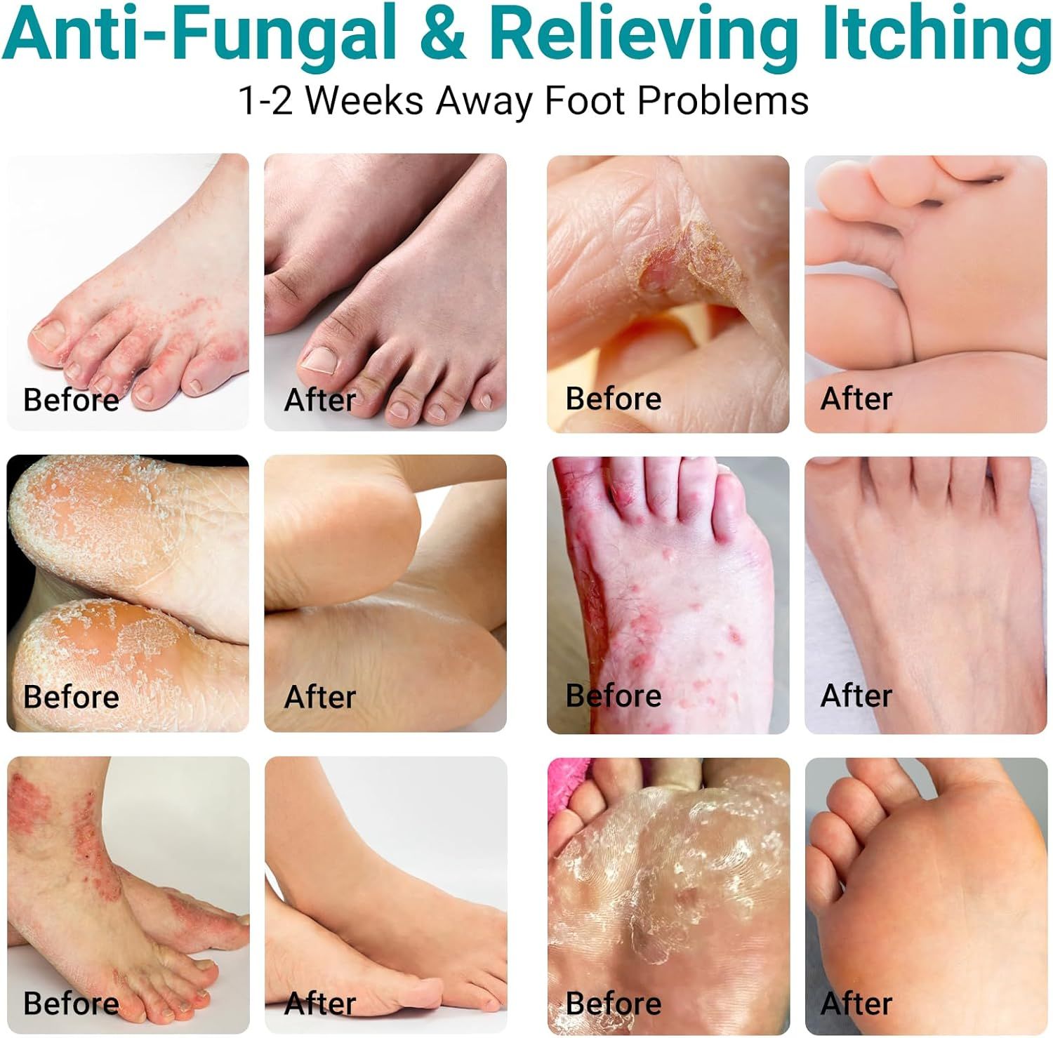 Vorher-Nachher-Bilder von Füßen mit Fußpilz. Verschiedene Stadien der Erkrankung werden gezeigt.