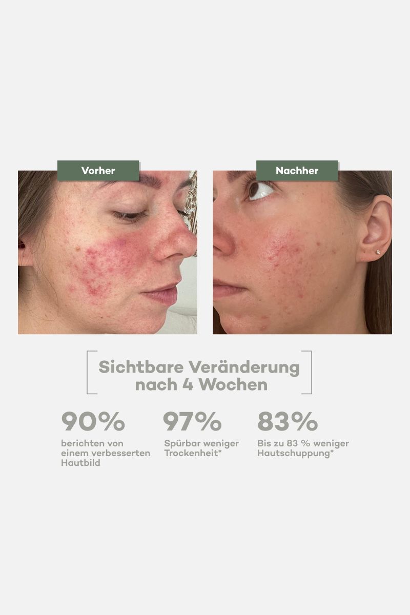 Vergleichsbilder: Vorher/Nachher. Hautrötungen reduziert. Text: Sichtbare Veränderung nach 4 Wochen. Prozentangaben.