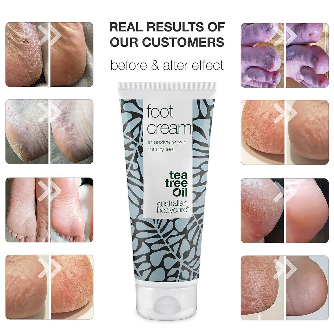 Vorher-Nachher-Bilder von Füßen. Tube Fußcreme in der Mitte. Text: "foot cream" und "australian bodycare".