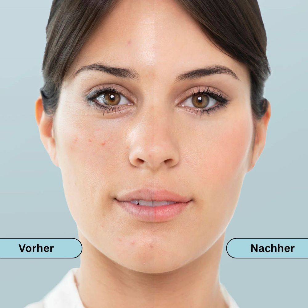 Gesicht einer Frau. Links: Vorher. Rechts: Nachher. Beschriftung: Vorher, Nachher.