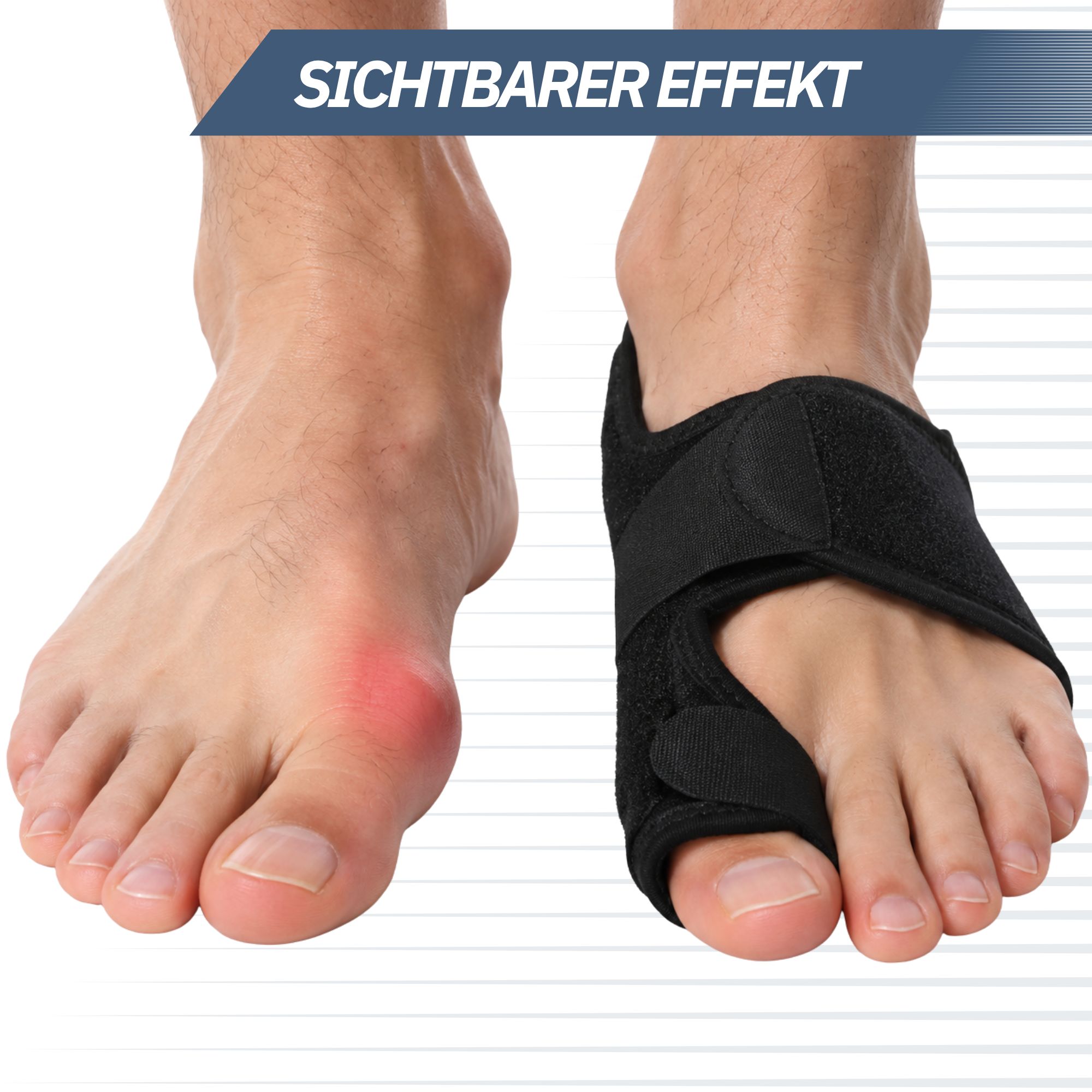 Vergleich: Fuß mit Ballenzeh und korrigierter Fuß mit Ballenzeh-Korrektor.