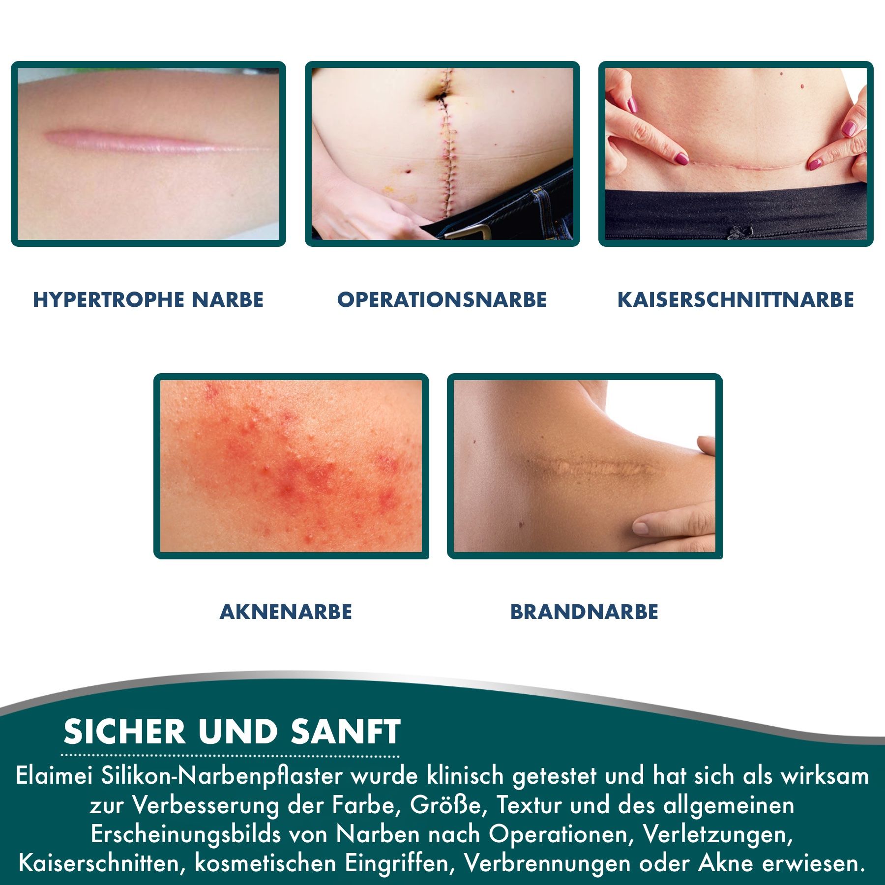 P-Beauty Silicone Wundpflaster für Narben