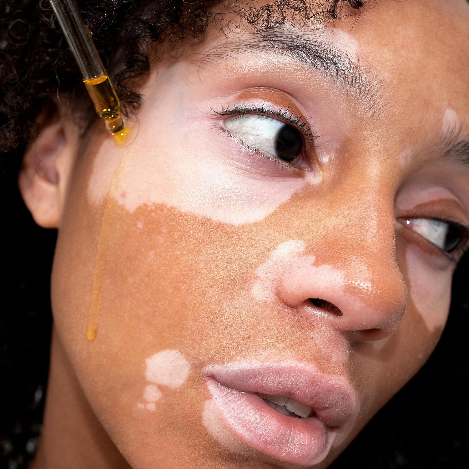 Nahaufnahme eines Gesichts mit Vitiligo, auf das ein Serum getropft wird.