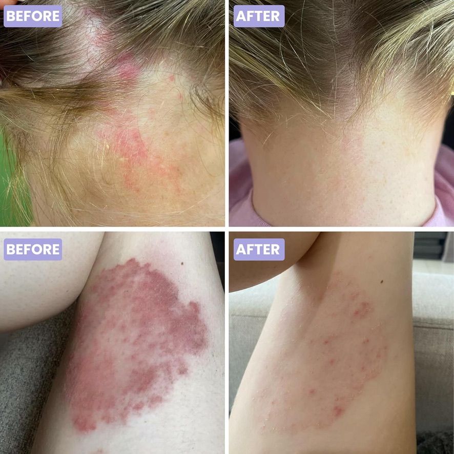FBA - Psoriasis Creme