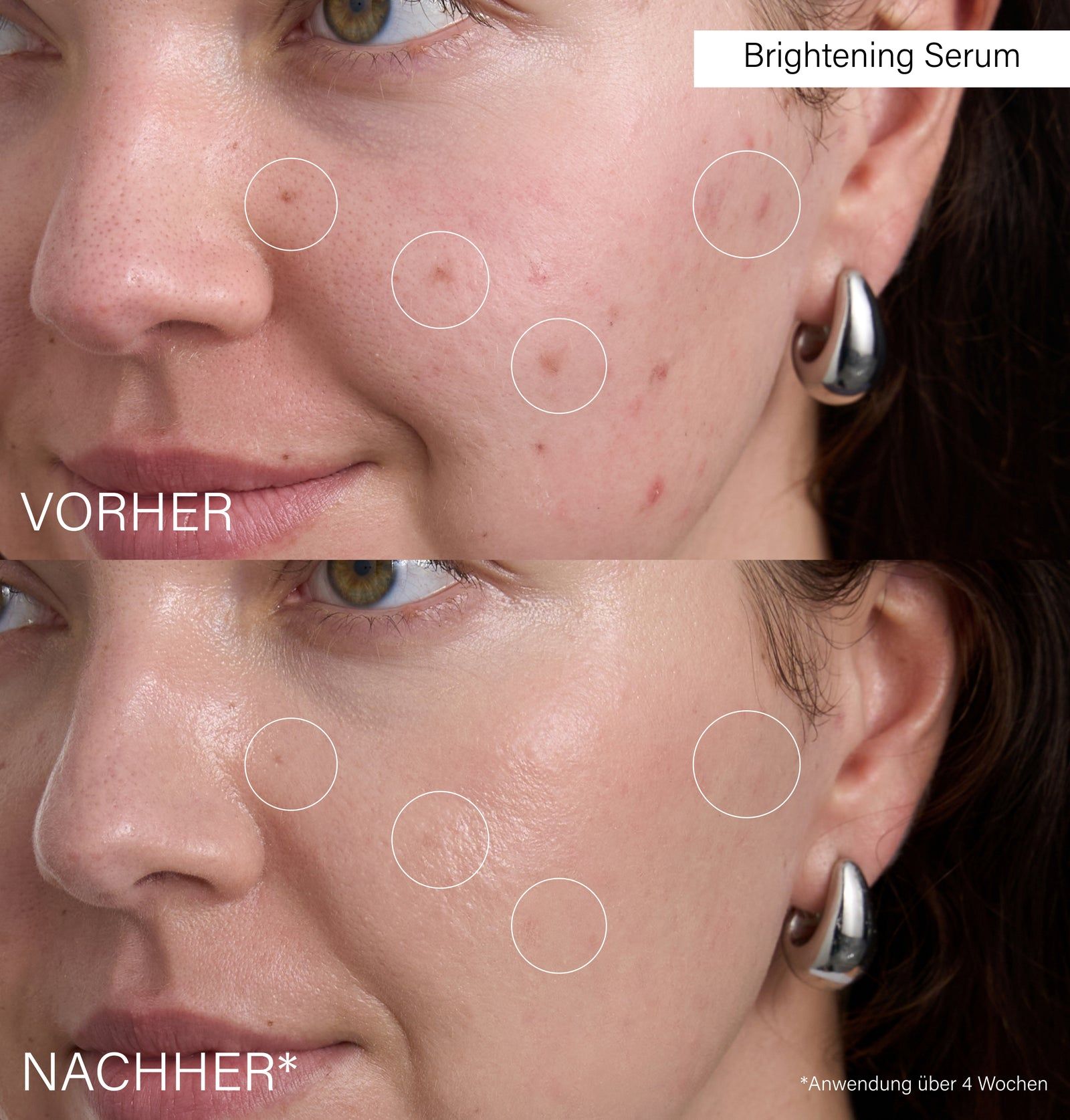 Gesicht, geteilt in Vorher und Nachher. Kreise markieren Hautstellen. Text: Vorher, Nachher. Anwendung über 4 Wochen.