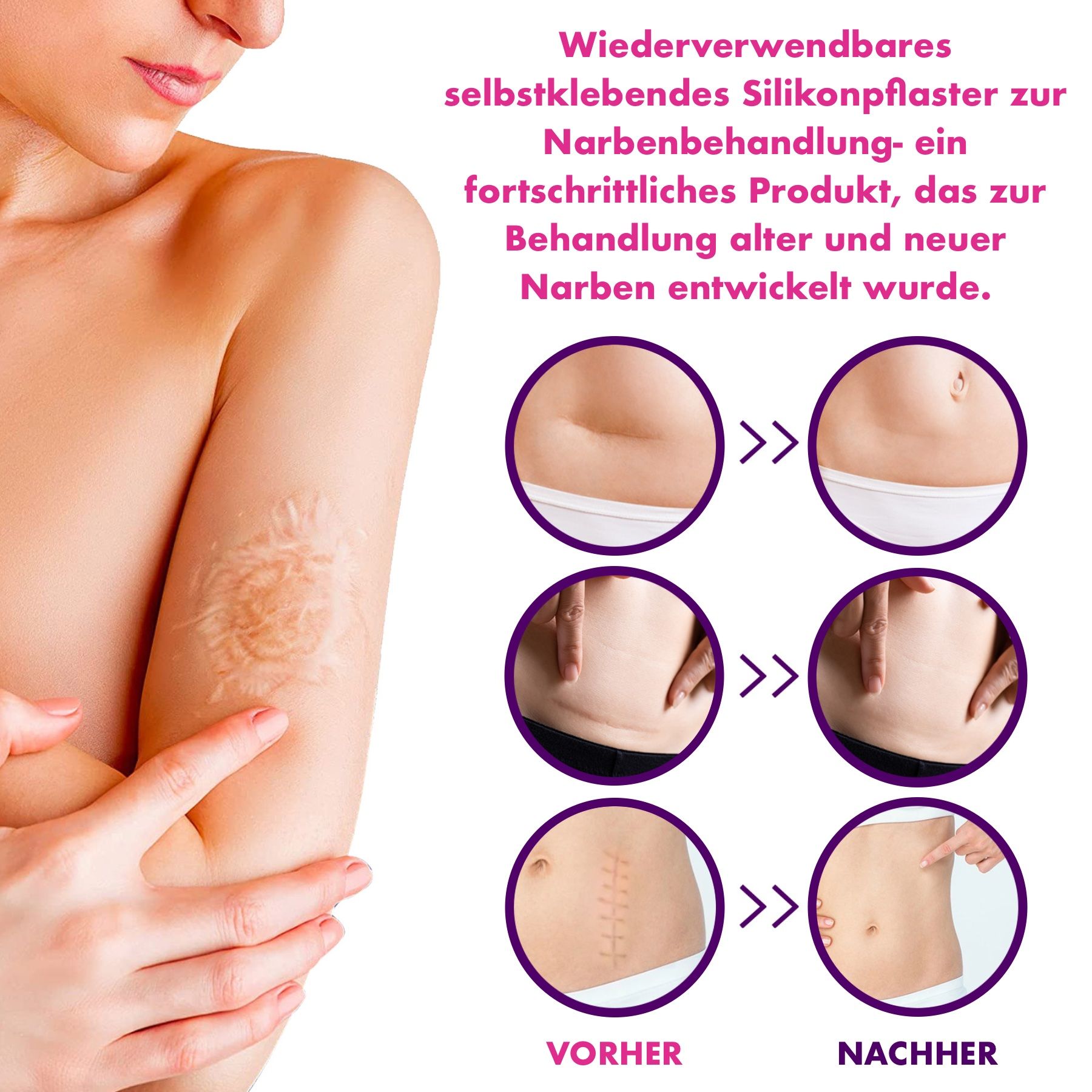 Illustration: Frau mit Narben am Arm und Bauch. Vorher-Nachher-Vergleich der Narbenbehandlung.