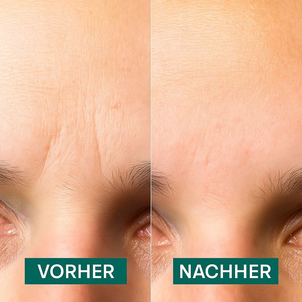 Vorher-Nachher-Vergleich von Haut. Links: Haut mit Falten. Rechts: Glatte Haut. Text: Vorher und Nachher.