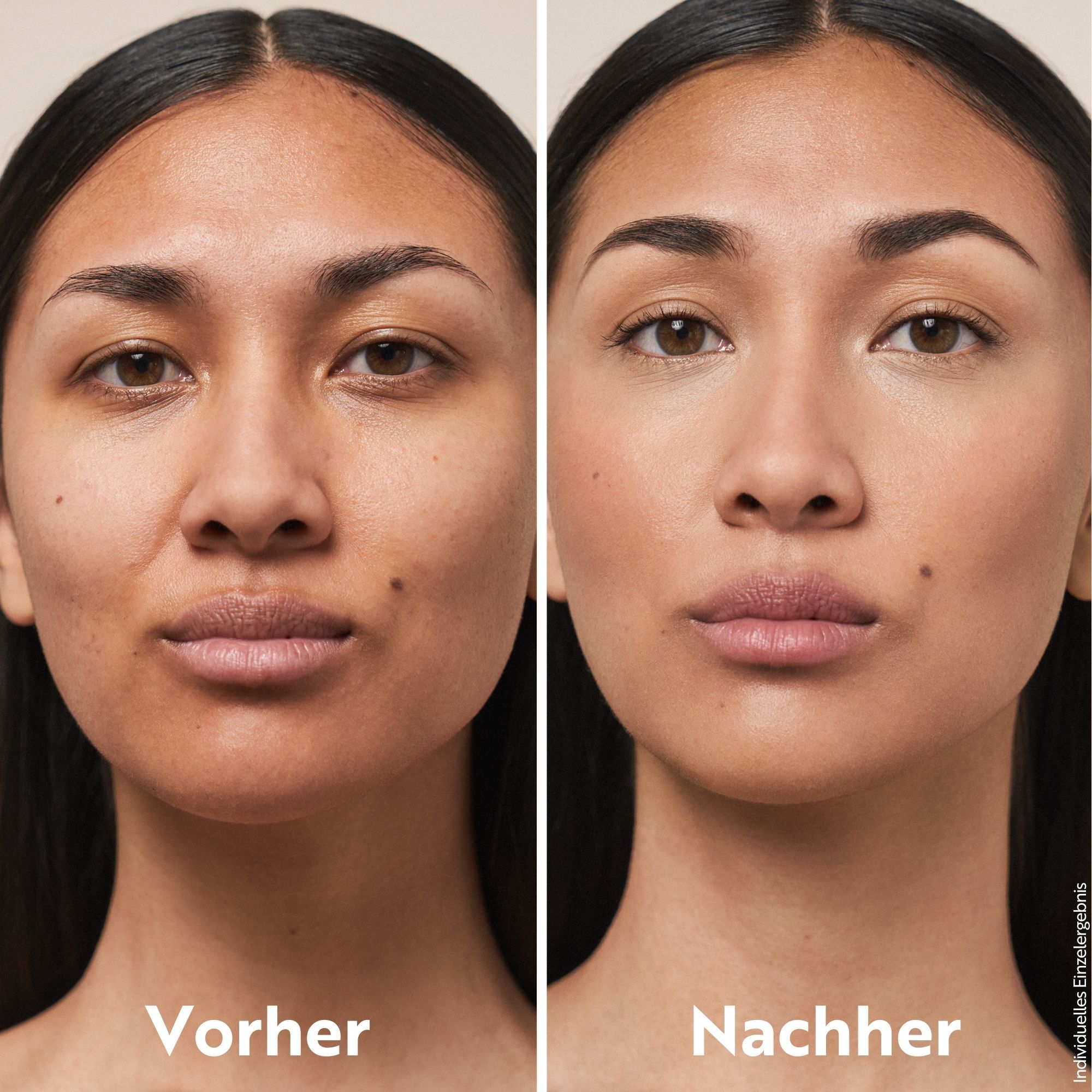 Vorher-Nachher-Vergleich. Gesicht einer Frau vor und nach der Anwendung. Deutliche Verbesserung des Hautbildes.