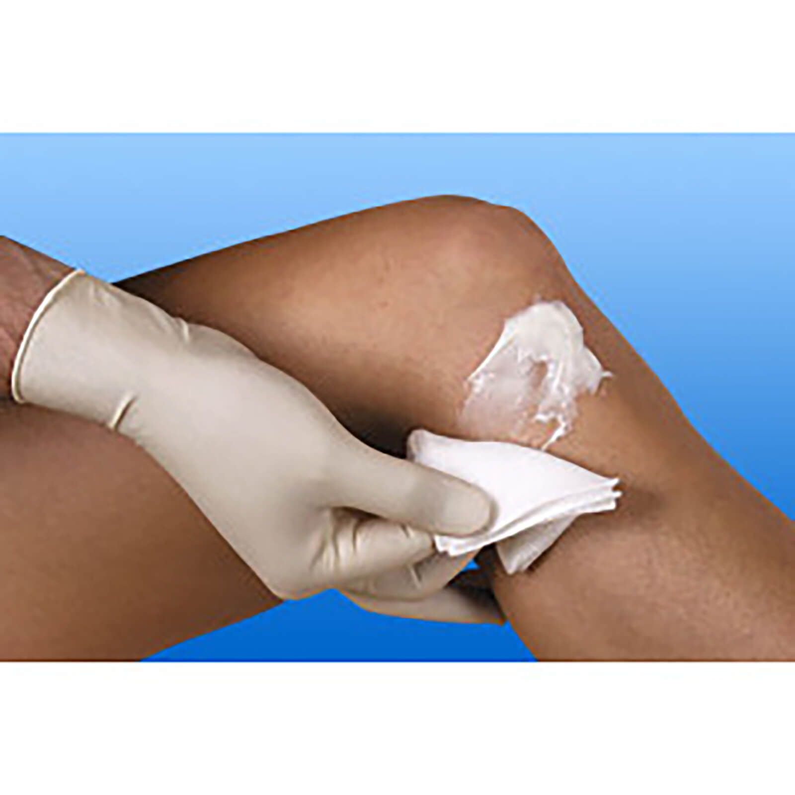 Person mit Handschuh hält Kompresse an Bein mit Creme. Kompresse weiß, Bein und Creme sichtbar.
