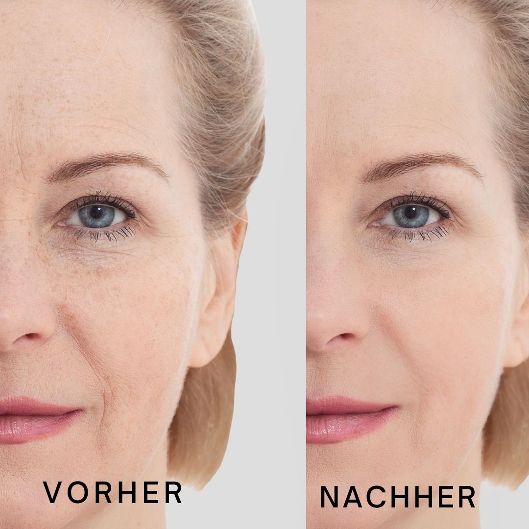 Gesicht, Vorher-Nachher-Vergleich. Haut mit Falten, dann glatte Haut. Text: Vorher, Nachher.
