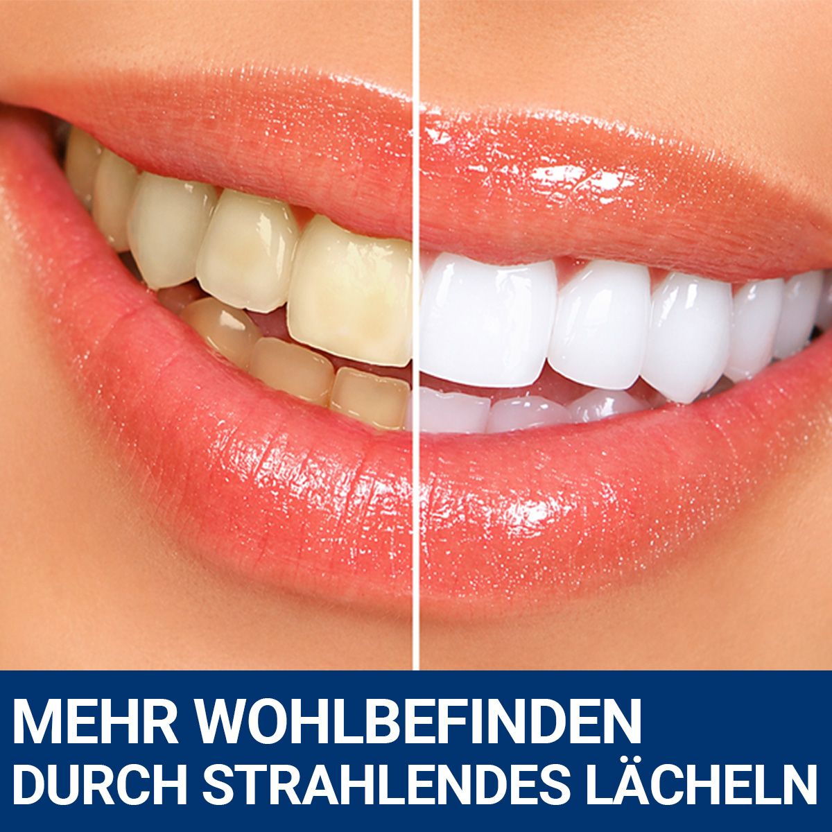 Oralflora Zahnaufhellung Bleaching – Whitening Strips, Zahnaufhellungsstreifen für weißere Zähne