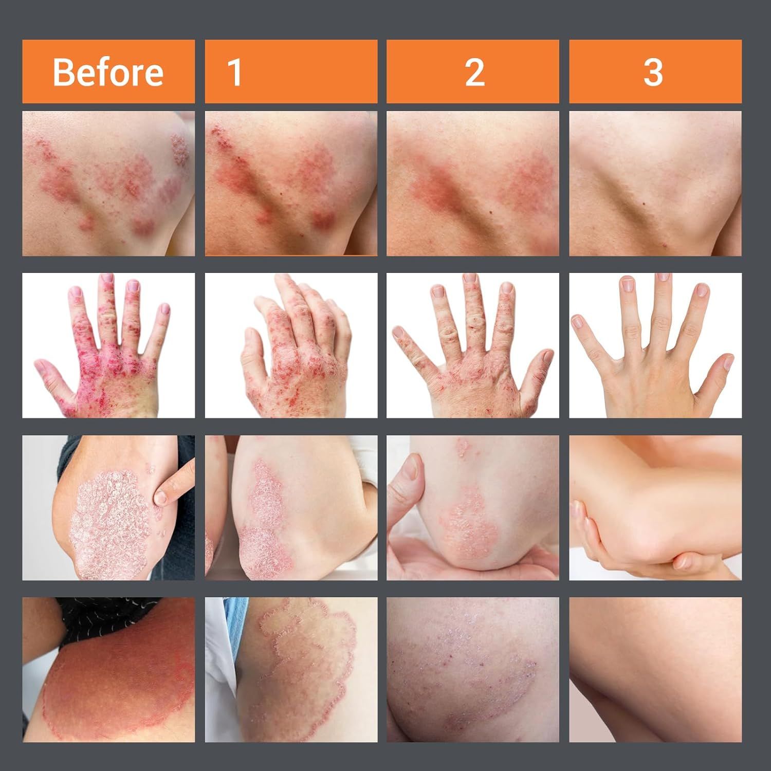 Vorher-Nachher-Bilder von Hautzuständen. Zeigt Hautausschläge, Ekzeme, Psoriasis und Jock Itch. 3 Stadien der Verbesserung.