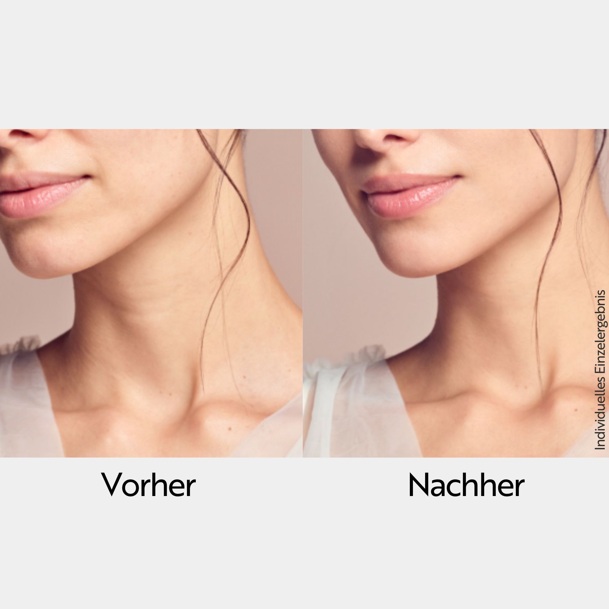 Vorher-Nachher-Vergleich. Hals und Kinn einer Frau. Links: Vorher. Rechts: Nachher.