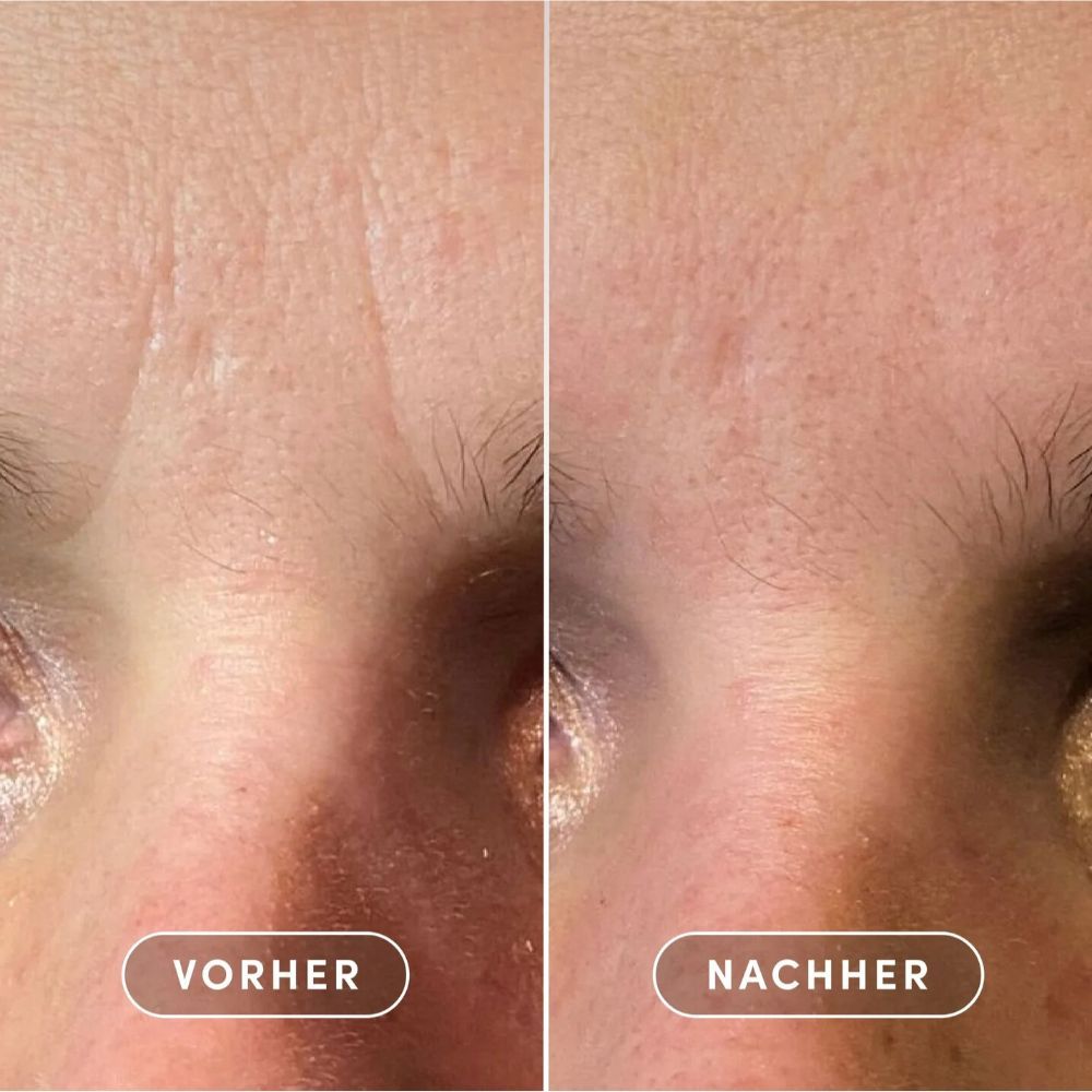 Vorher-Nachher-Vergleich. Haut mit Falten, Haut ohne Falten.