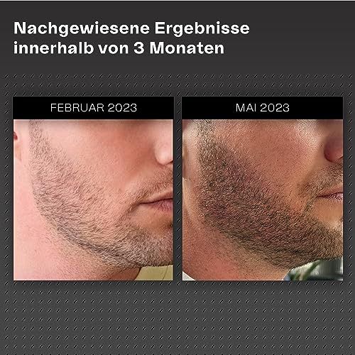 Vorher-Nachher-Vergleich. Fotos von Bartwuchs. Ergebnisse nach 3 Monaten.