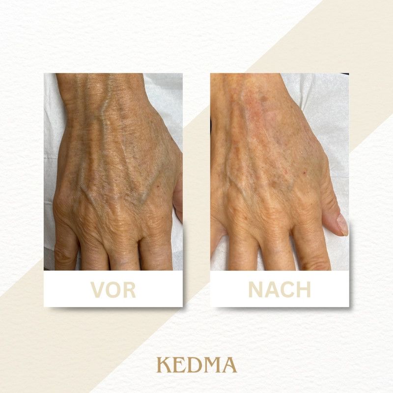 Vorher-Nachher-Vergleich einer Hand mit sichtbaren Venen und Pigmentflecken.