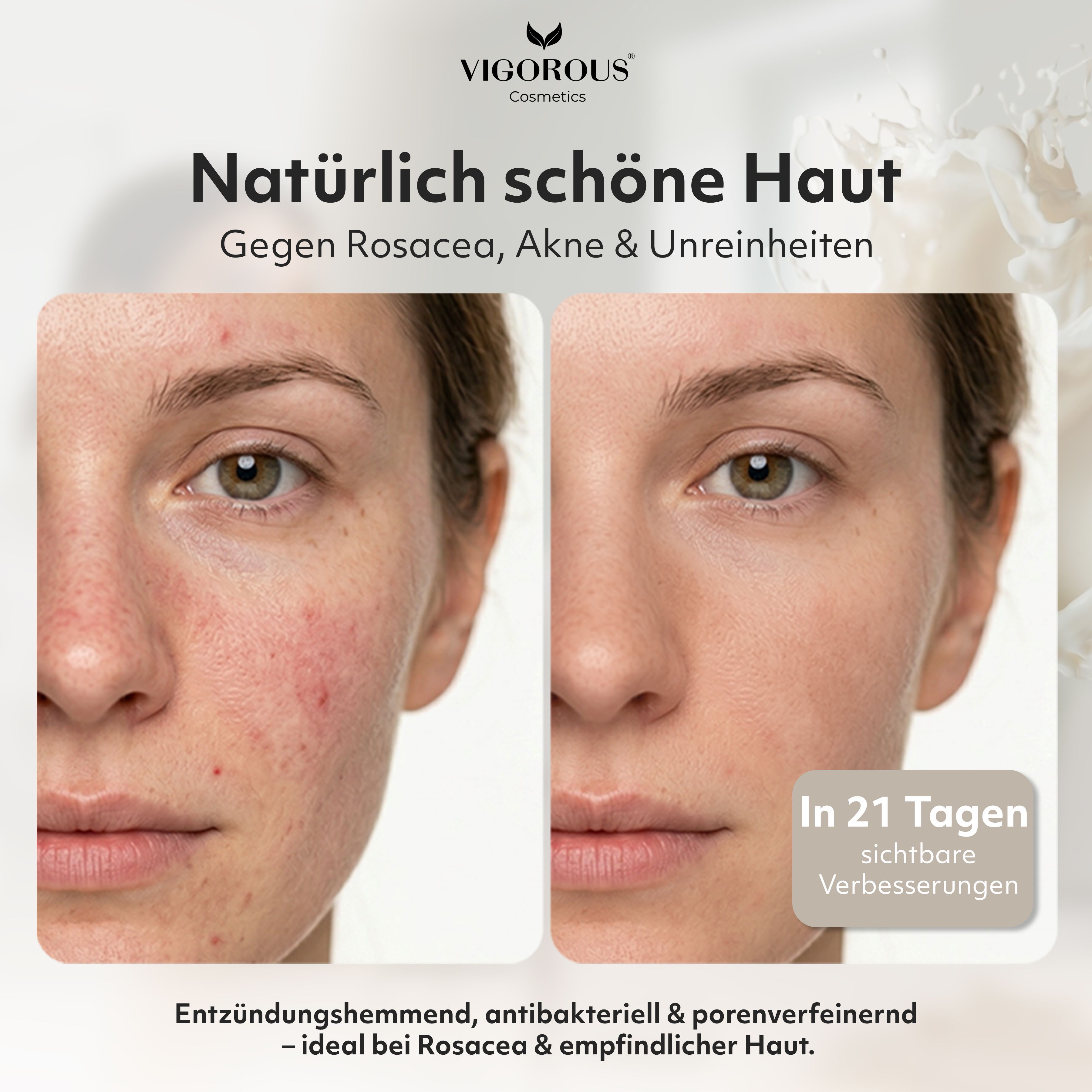 Vorher-Nachher-Bild. Gesicht mit Rötungen, dann klarere Haut. Text: Gegen Rosacea, Akne. 21 Tage. VIGOROUS Cosmetics.