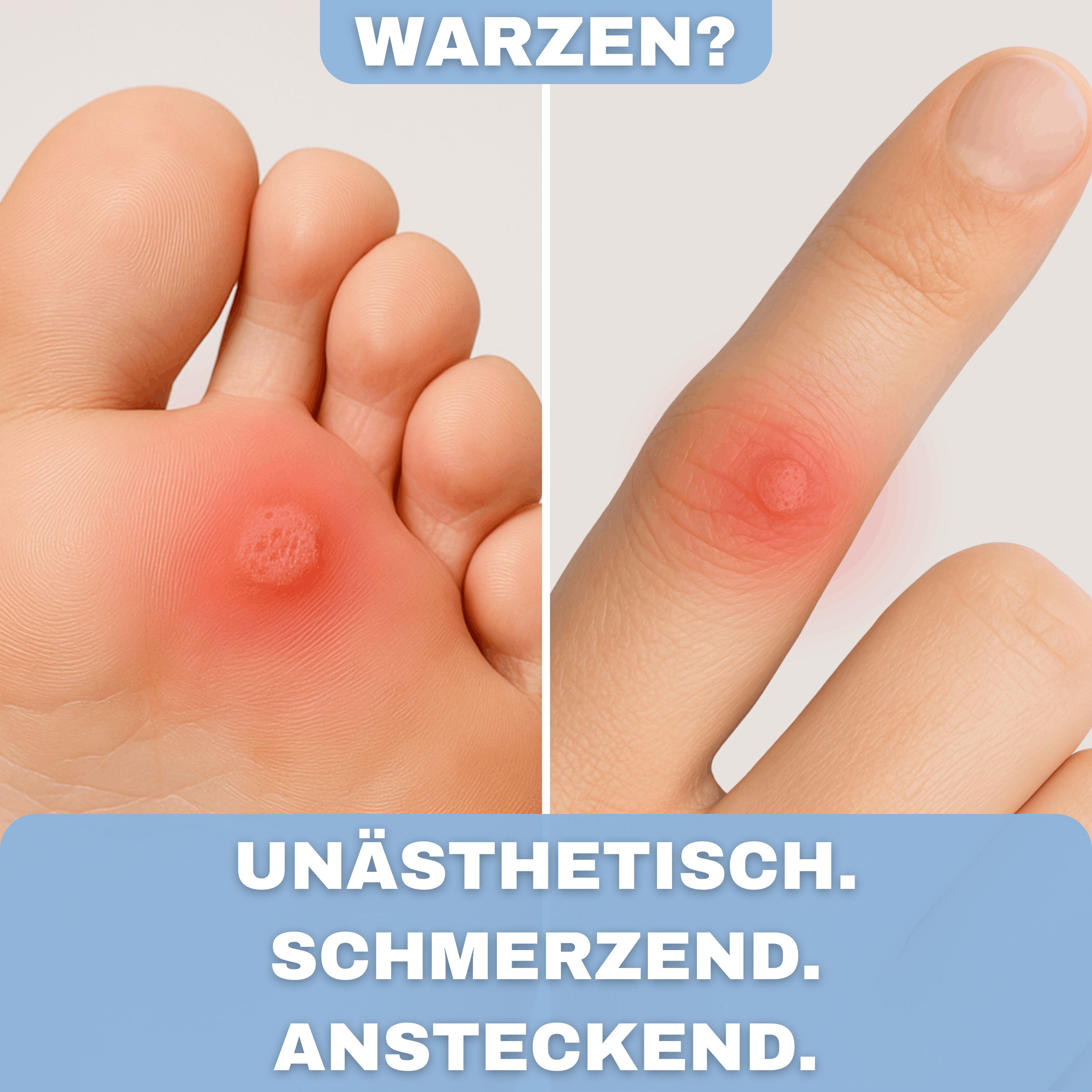 Health Press® Warzen Tinktur