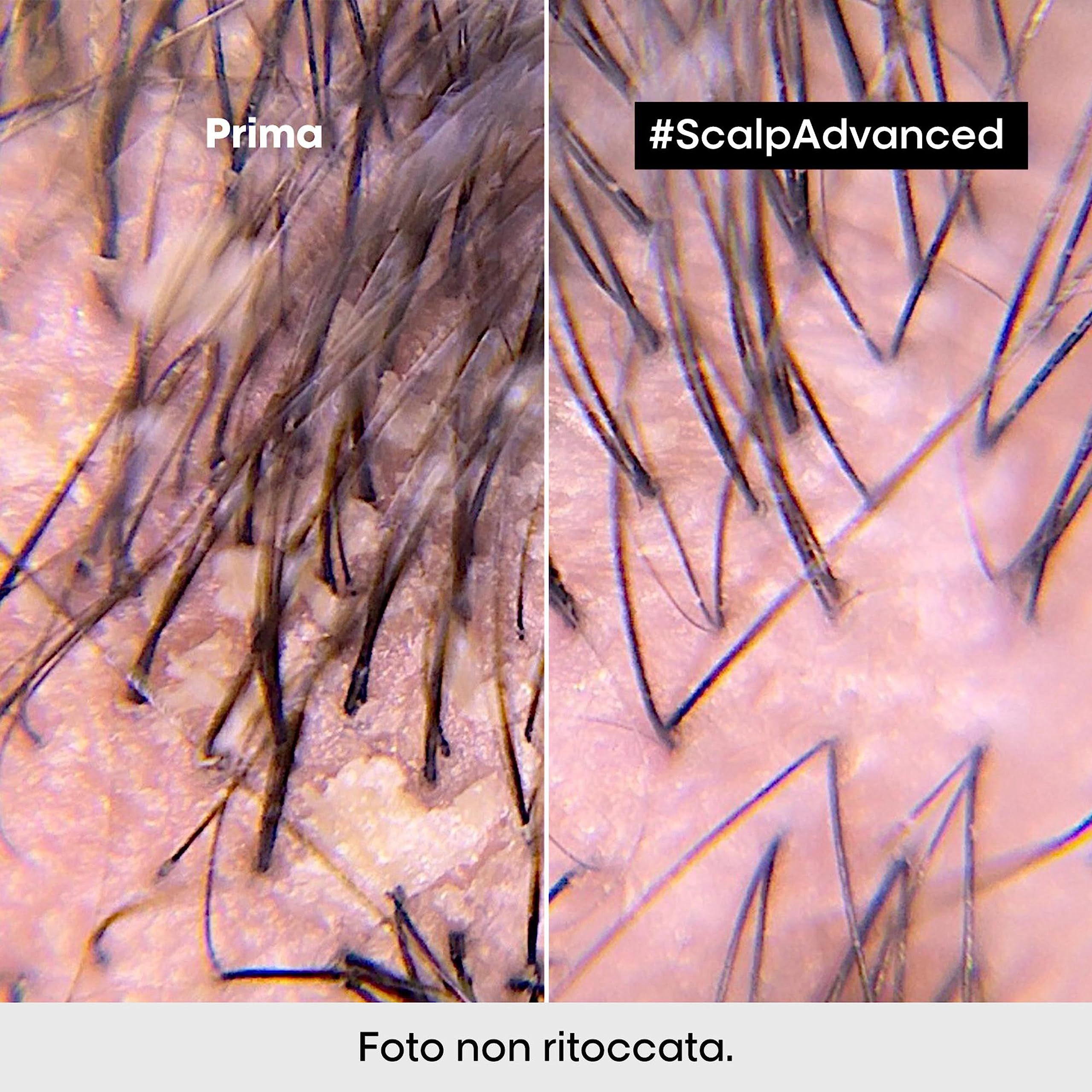 Mikroskopische Nahaufnahme der Kopfhaut. Links: Kopfhaut mit Schuppen. Rechts: Saubere Kopfhaut. Text: Foto nicht retuschiert.