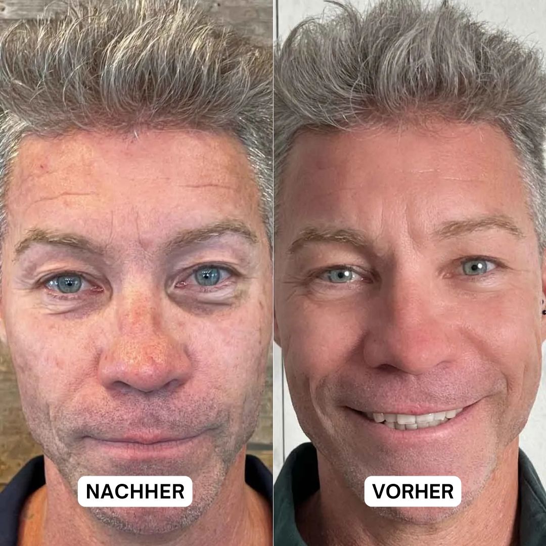 Vorher-Nachher-Vergleich. Mann mit Falten, dann glatteres Gesicht. Text: NACHHER, VORHER.