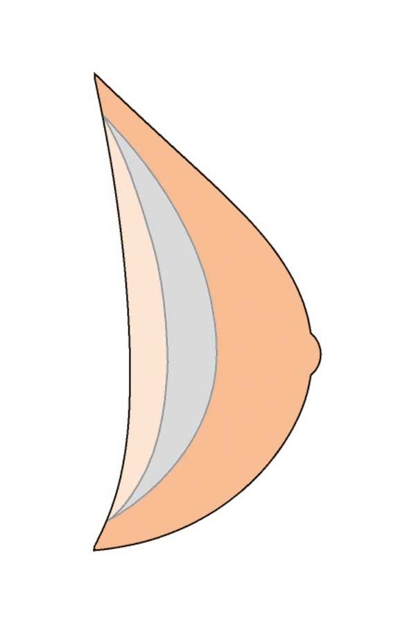 Schematische Darstellung einer Brustprothese. Dreieckige Form mit verschiedenen Schichten in Hauttönen.