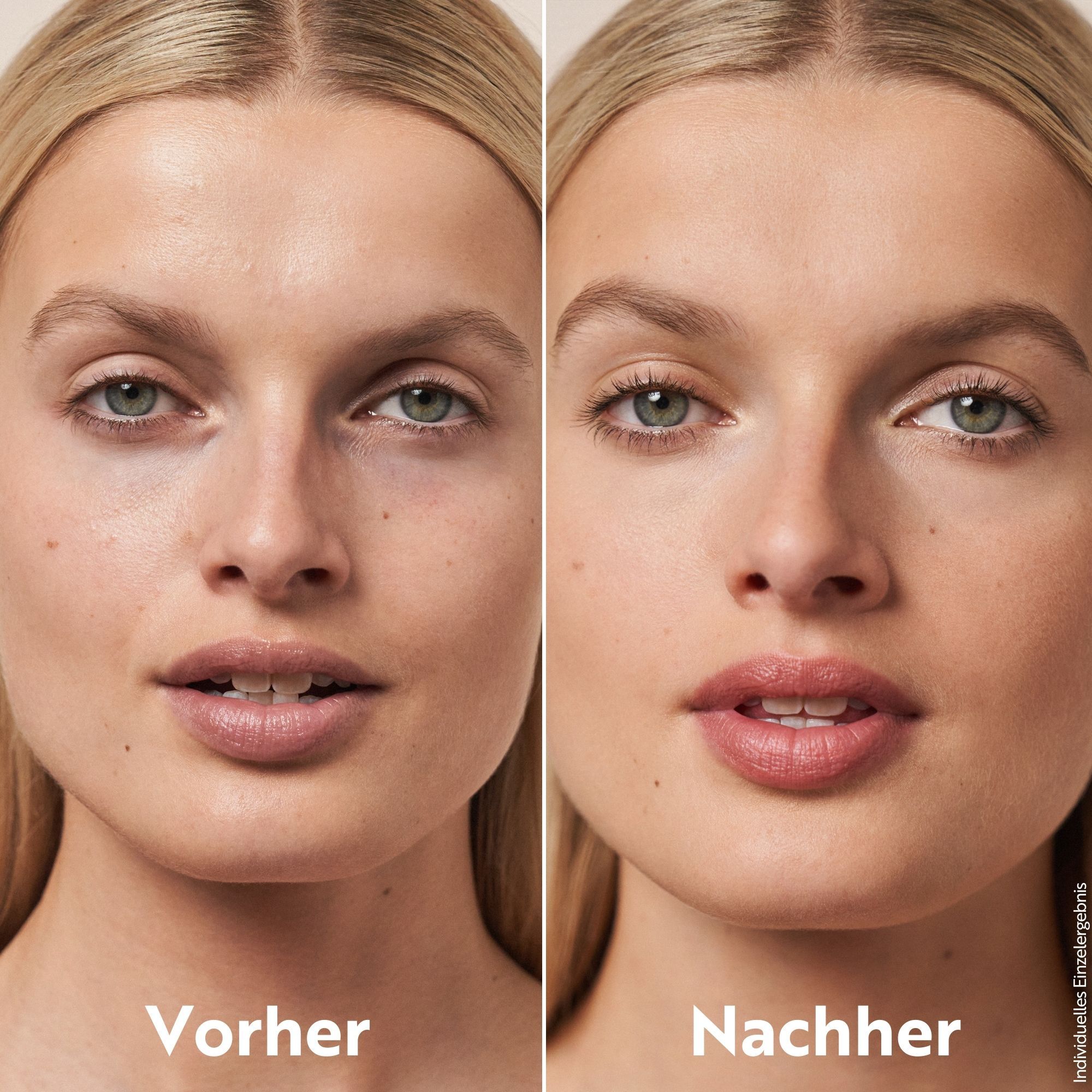 Vorher-Nachher-Vergleich. Frau mit Hautunreinheiten, dann mit ebenmäßigem Teint. Text: Vorher, Nachher. Individuelle Ergebnisse.