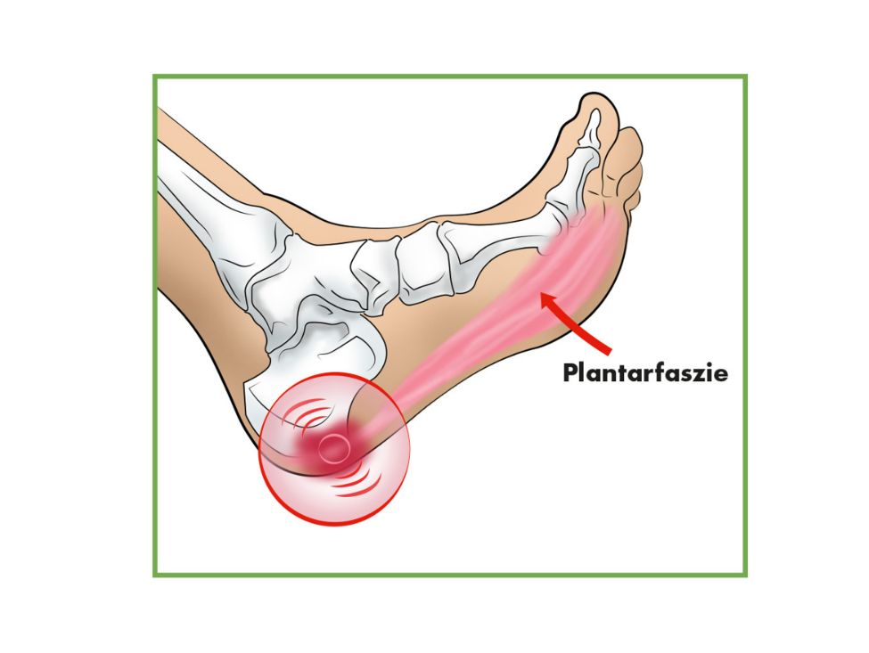 Illustration eines Fußes mit Plantarfasziitis. Roter Kreis markiert die Ferse. Pfeil zeigt auf die Plantarfaszie.