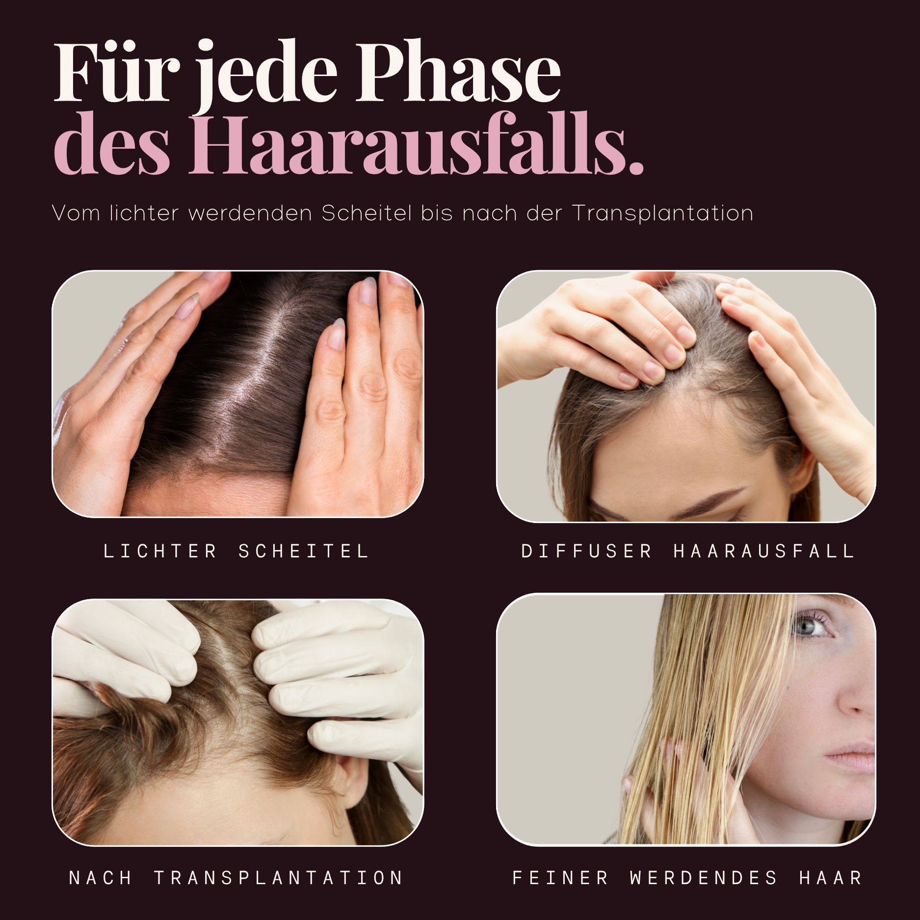 Vier Phasen des Haarausfalls: lichter Scheitel, diffuser Haarausfall, nach Transplantation, feiner werdendes Haar.
