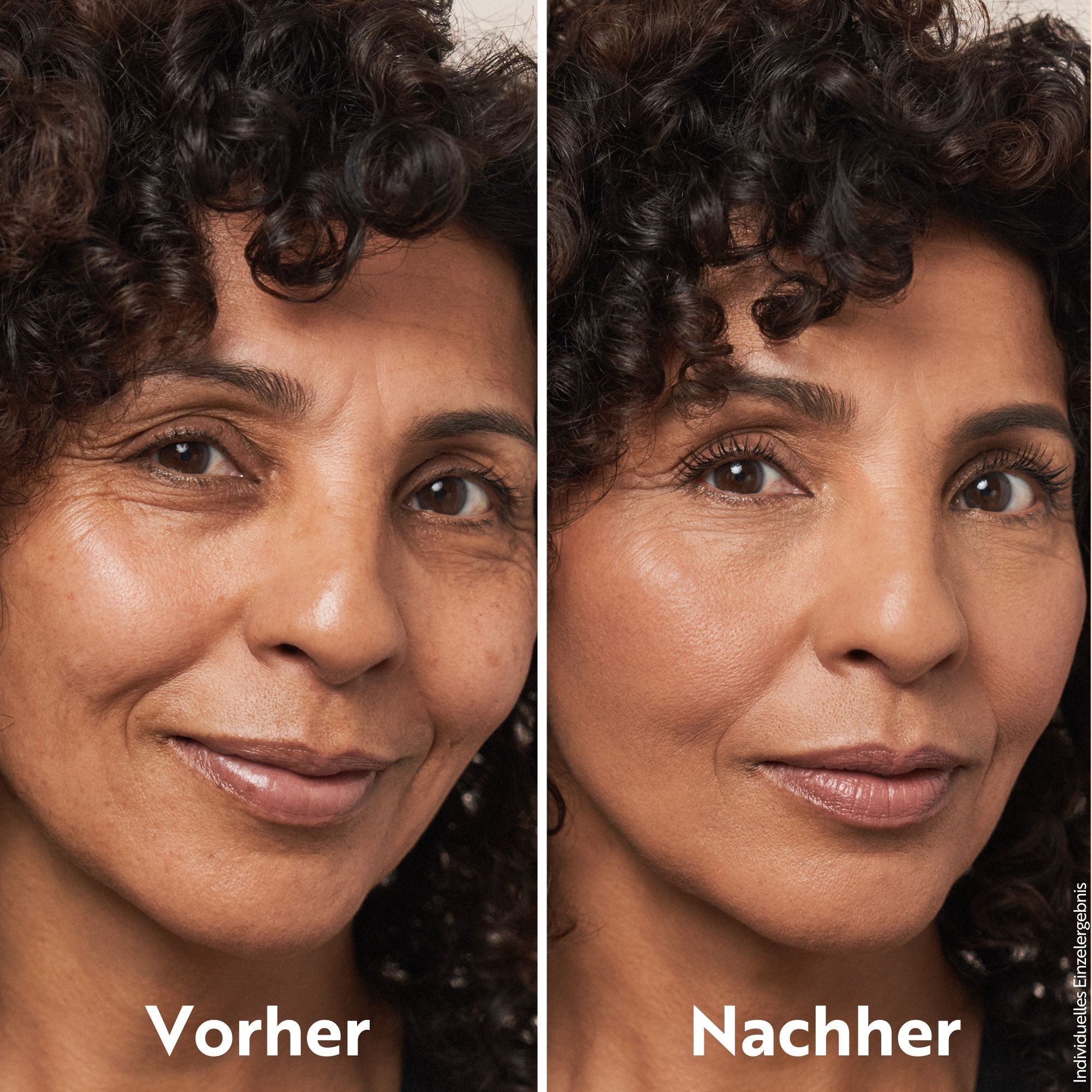 Vorher-Nachher-Vergleich. Gesicht einer Frau. Links: Vorher. Rechts: Nachher. Haut wirkt ebenmäßiger und strahlender.