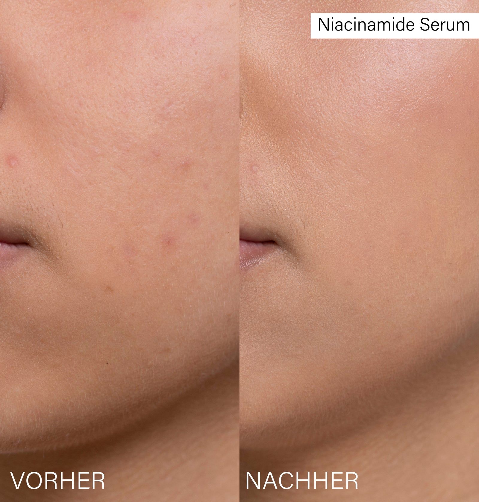 Gesichtshälfte vor und nach der Anwendung. Links: Hautunreinheiten. Rechts: Glattere Haut. Text: Vorher, Nachher, Niacinamid Serum.