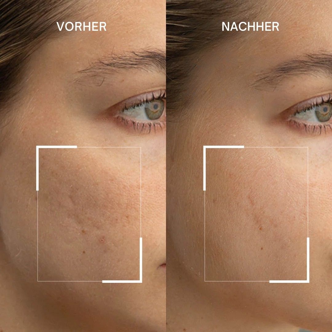 Vorher-Nachher-Vergleich. Gesicht mit Hautunreinheiten, dann glattere Haut.