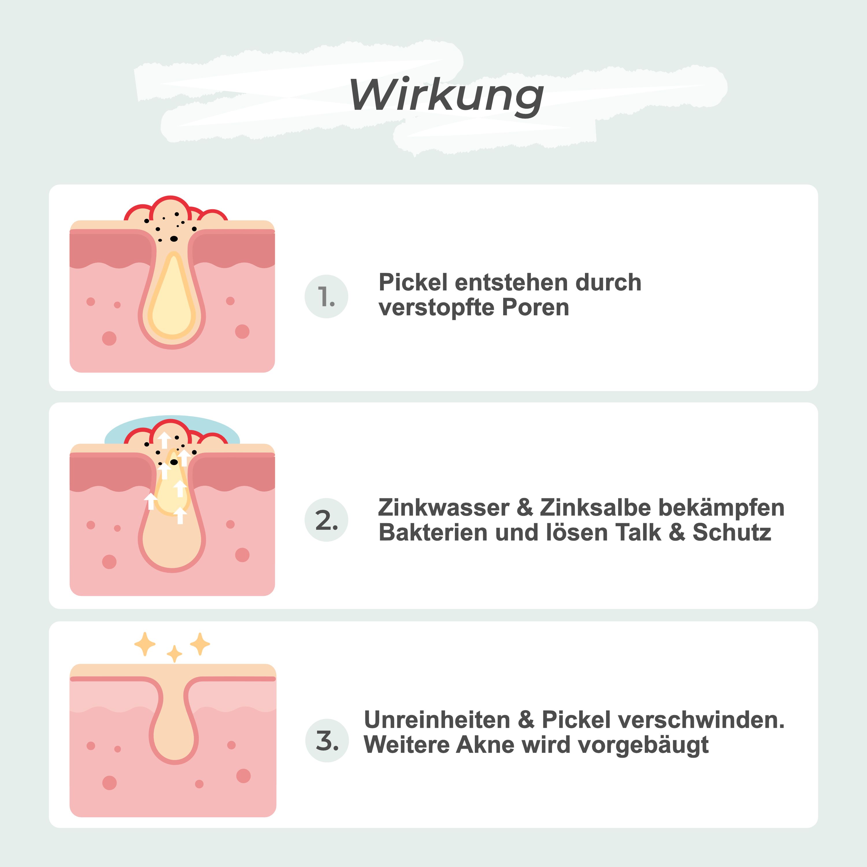 Schematische Darstellung der Haut. Text: Pickel entstehen, Zinkwasser & Zinksalbe bekämpfen, Unreinheiten verschwinden.