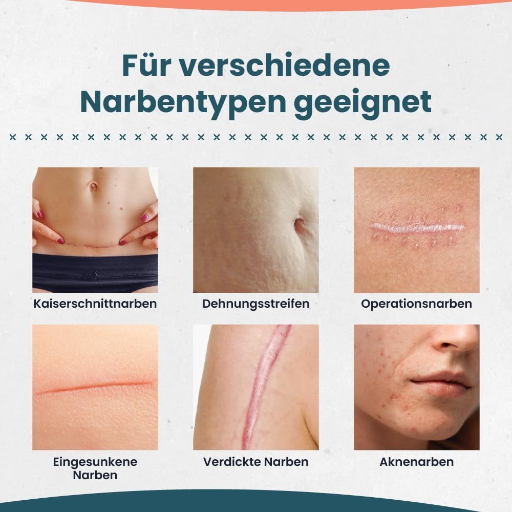 Fotos von verschiedenen Narbentypen: Kaiserschnitt, Dehnungsstreifen, Operationsnarben, eingesunkene Narben, verdickte Narben, Akennarben.