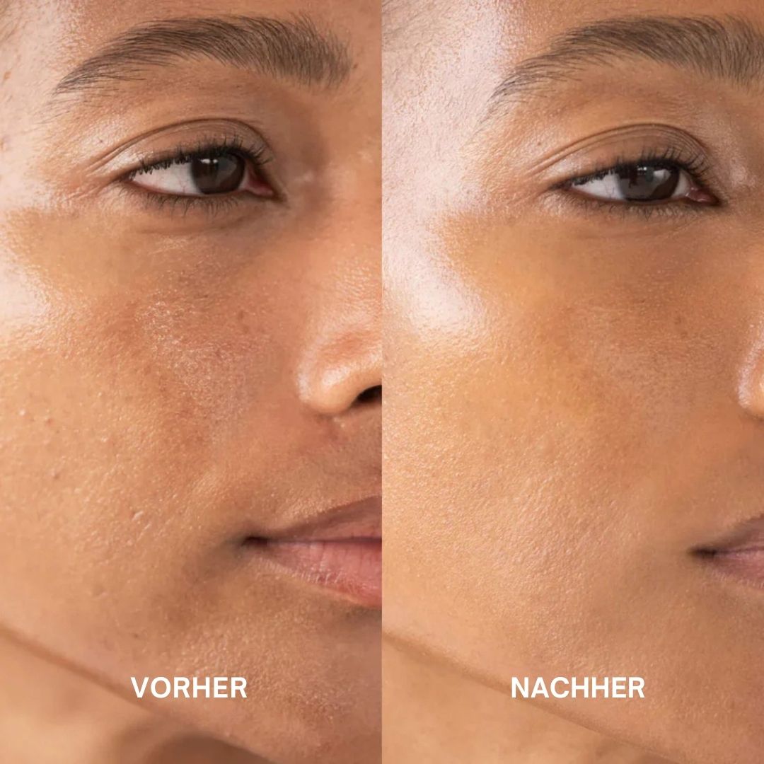 Vorher-Nachher-Bild. Gesicht mit Hautunreinheiten, dann glatte Haut. Text: Vorher, Nachher.