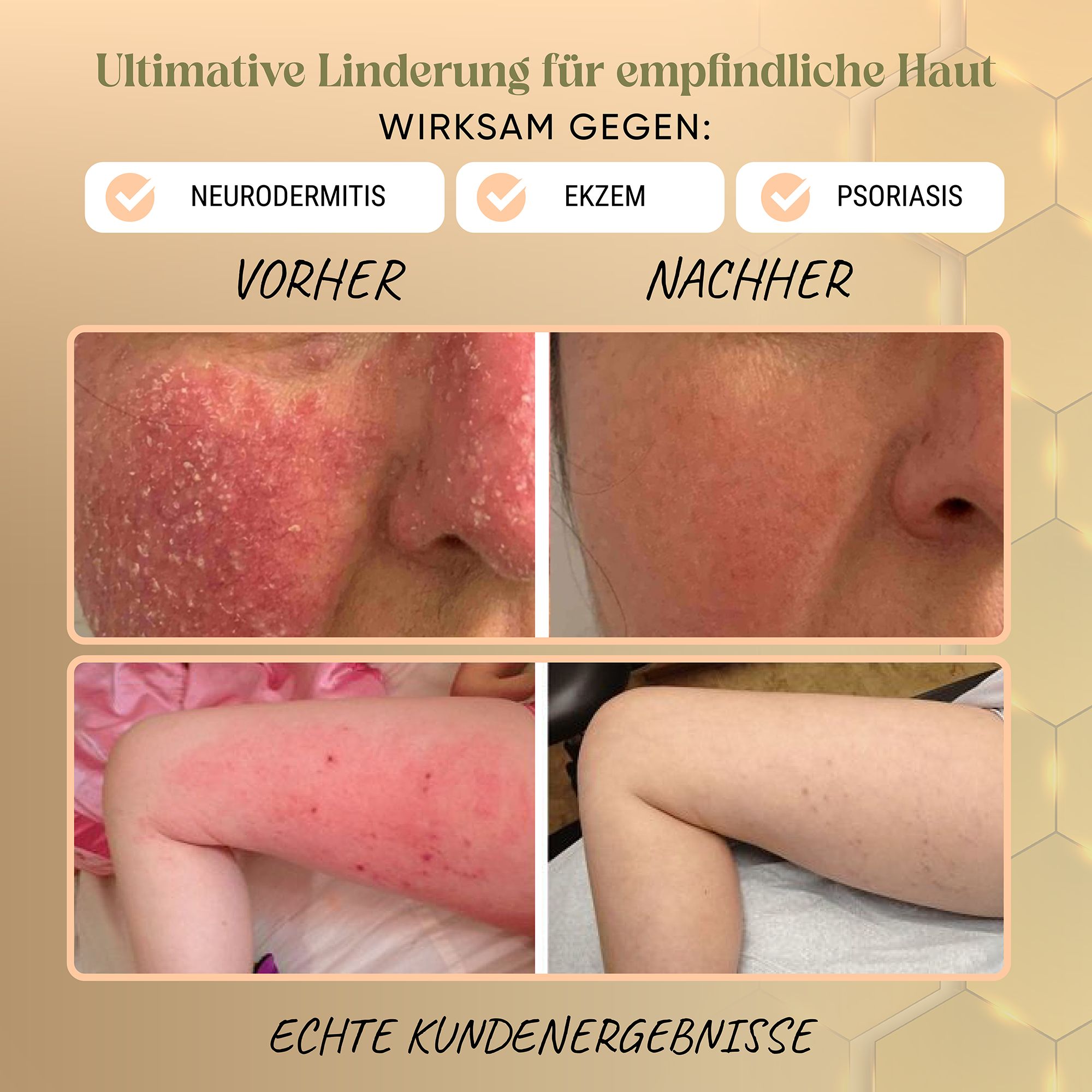 Vorher-Nachher-Bilder zeigen Hautverbesserung bei Neurodermitis, Ekzemen und Psoriasis. Text: 'Echte Kundenergebnisse'.