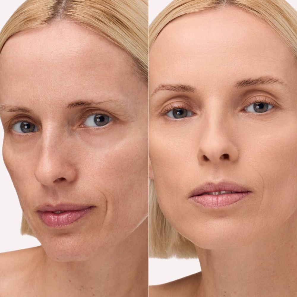 Vorher-Nachher-Vergleich eines Gesichts. Links: Haut mit Unreinheiten. Rechts: Haut mit Make-up.