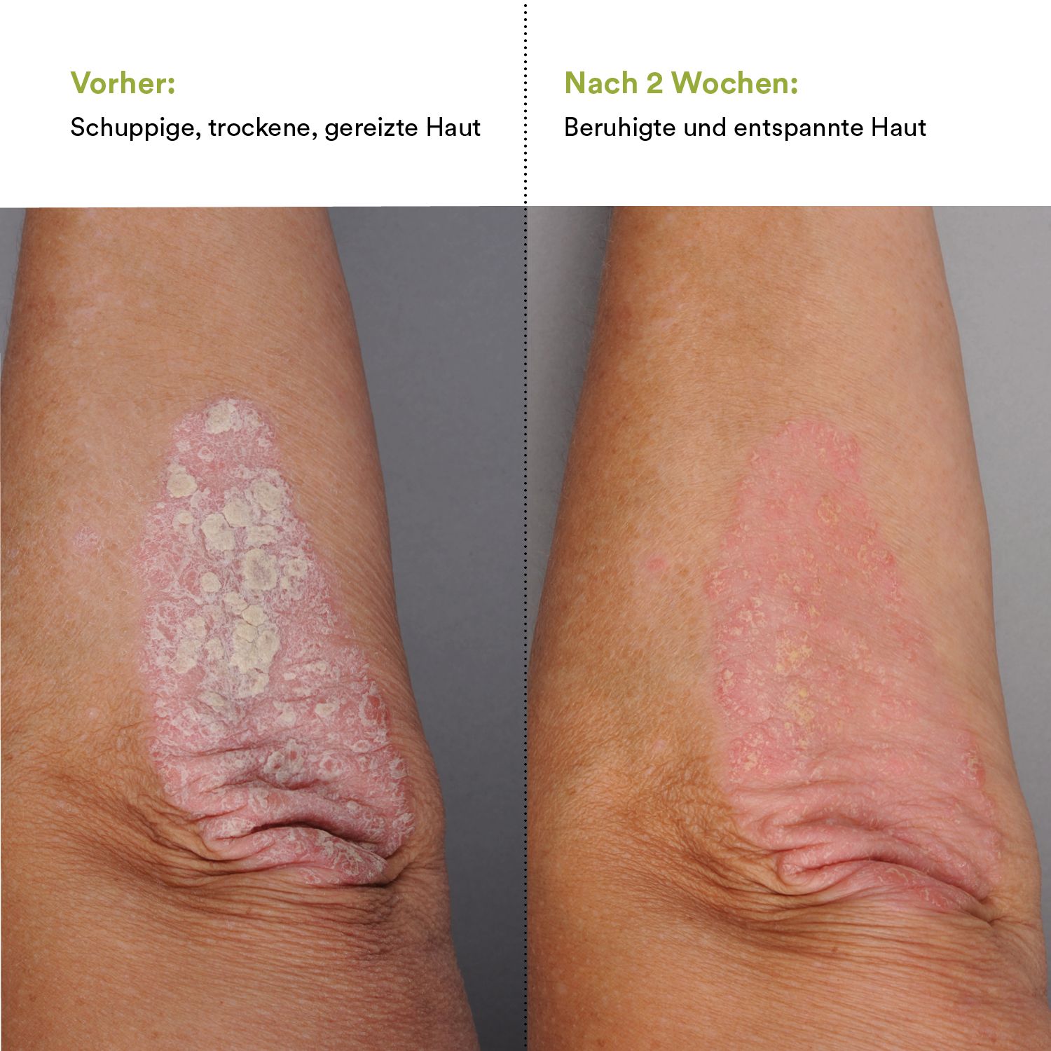 Vergleich: Vorher: schuppige, trockene Haut. Nach 2 Wochen: beruhigte Haut. Arme mit Hautausschlag.