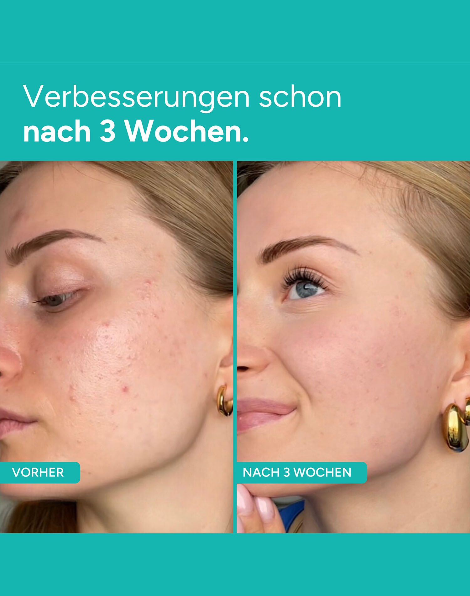 Professionelles Kaltplasma-Kosmetikgerät GLIM90