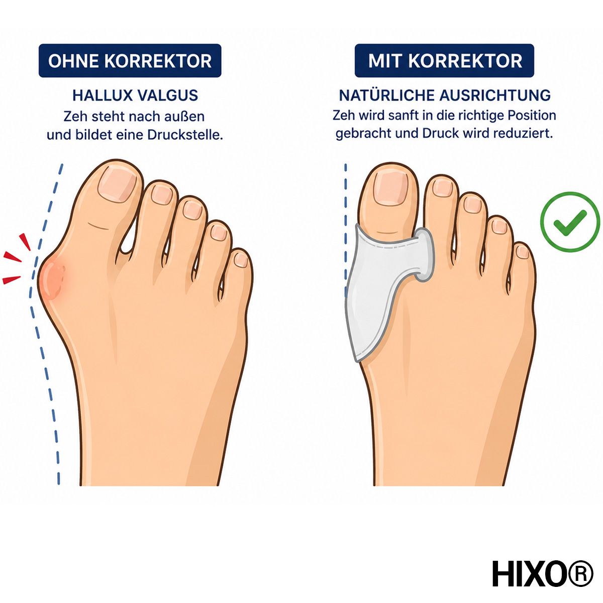 HIXO Zehenspreizer Hallux Valgus - Ballenschutz & Zehentrenner aus weichem Silikon ohne BPA