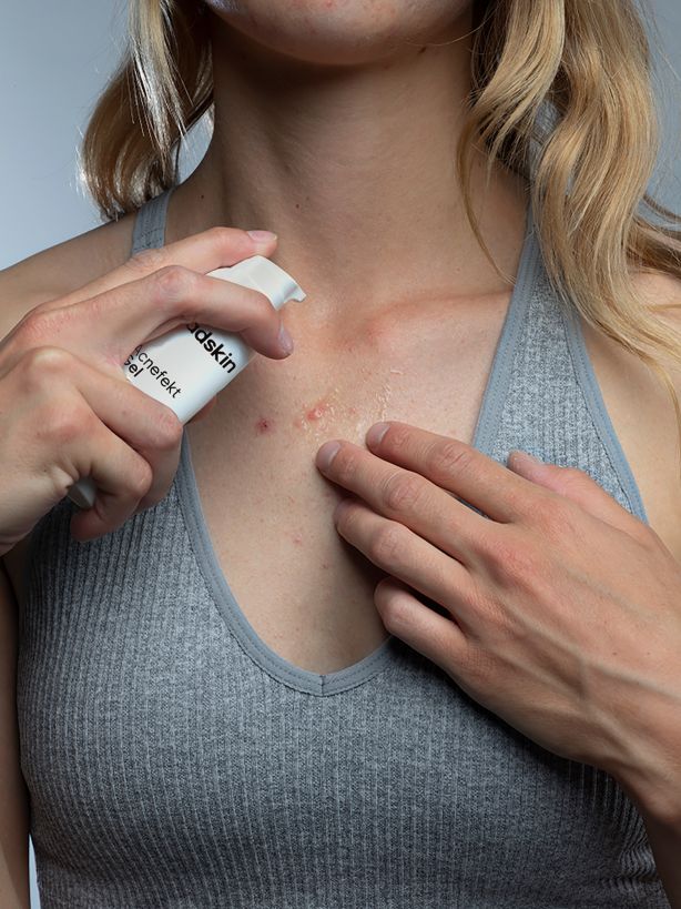 Person trägt Gladskin Acnefekt Gel auf Pickel auf der Brust auf.