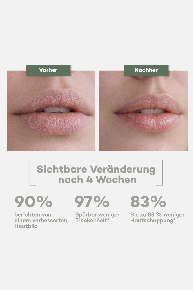 Vorher-Nachher-Vergleich von Lippen. Text: Sichtbare Veränderung nach 4 Wochen. Prozentangaben zu Verbesserung.