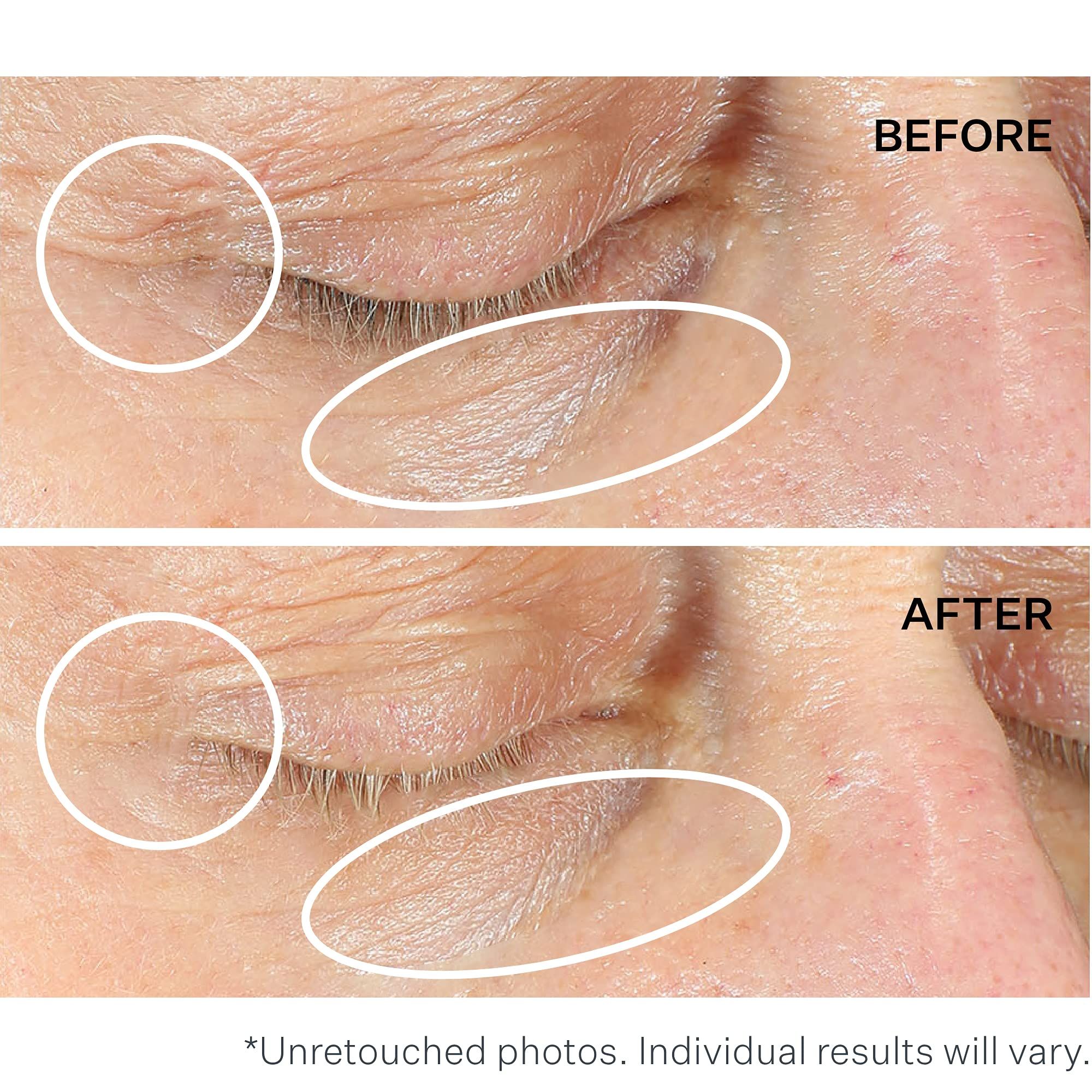 Vorher-Nachher-Vergleich von Augenpartien. Markierungen zeigen Faltenreduzierung. Text: Before, After.