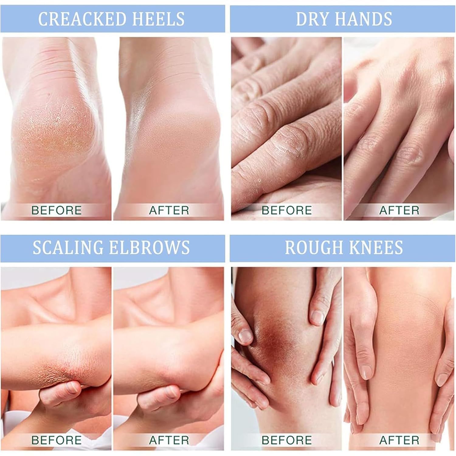 Vorher-Nachher-Bilder: rissige Fersen, trockene Hände, schuppige Ellbogen, raue Knie. Zeigen Verbesserungen nach der Anwendung.