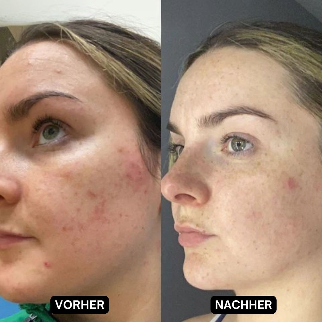 Vorher-Nachher-Foto einer Frau. Haut mit Pickeln und Rötungen. Nachher: deutlich verbesserte Haut.