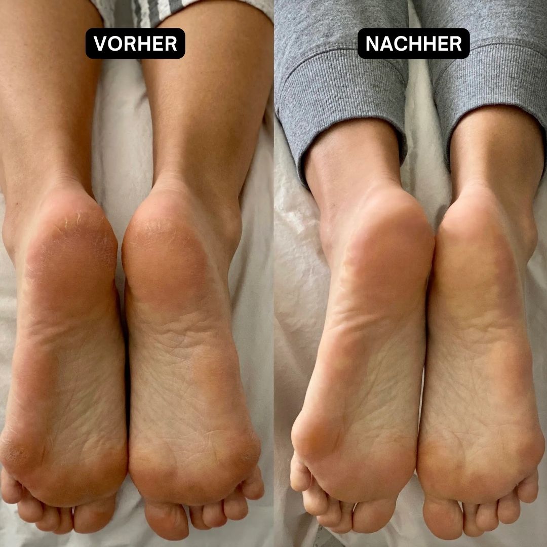 Vorher-Nachher-Vergleich von Füßen. Links: rissige Fersen. Rechts: glatte Füße. Text: Vorher, Nachher.