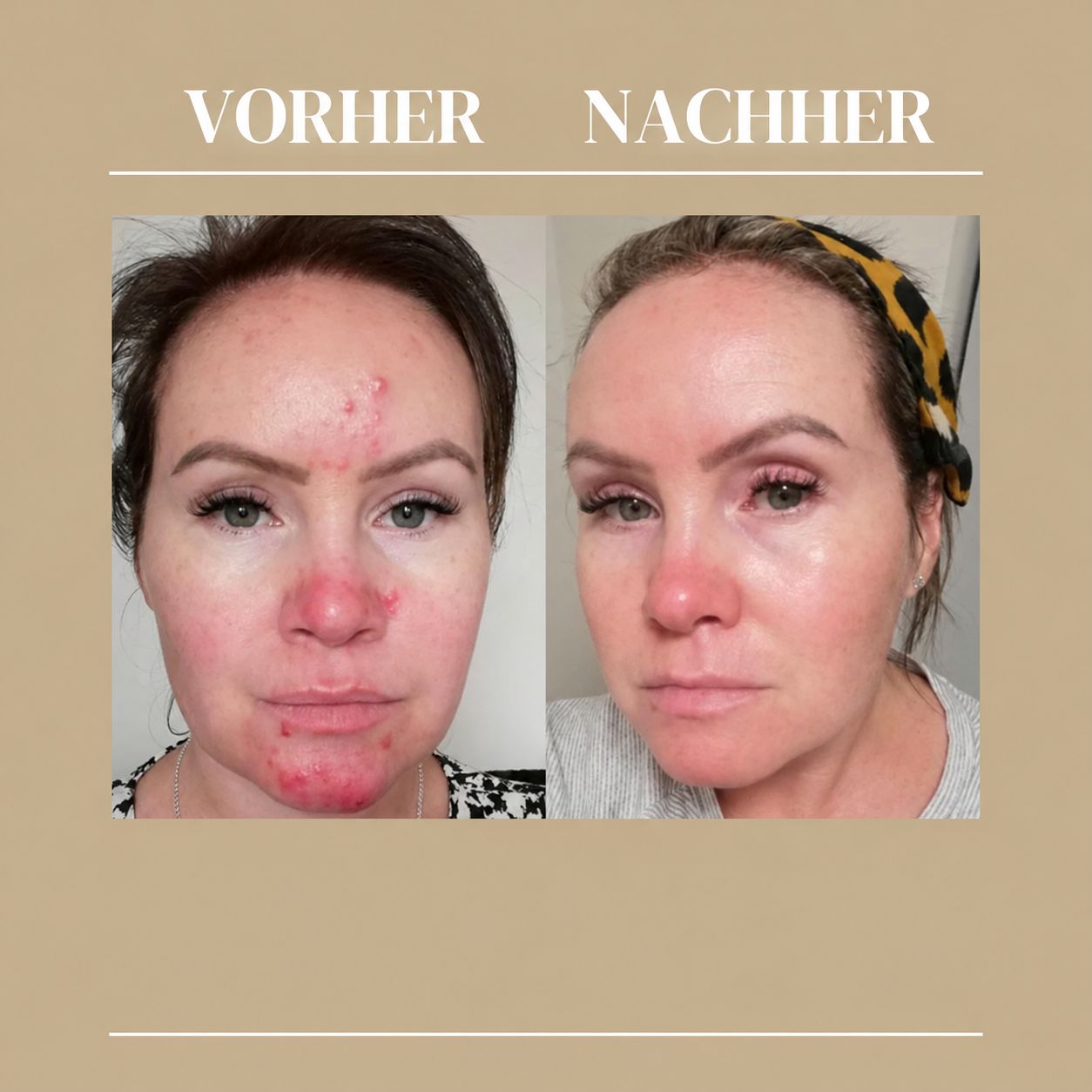 Vorher-Nachher-Vergleich einer Frau mit Hautproblemen, die sich verbessert haben.