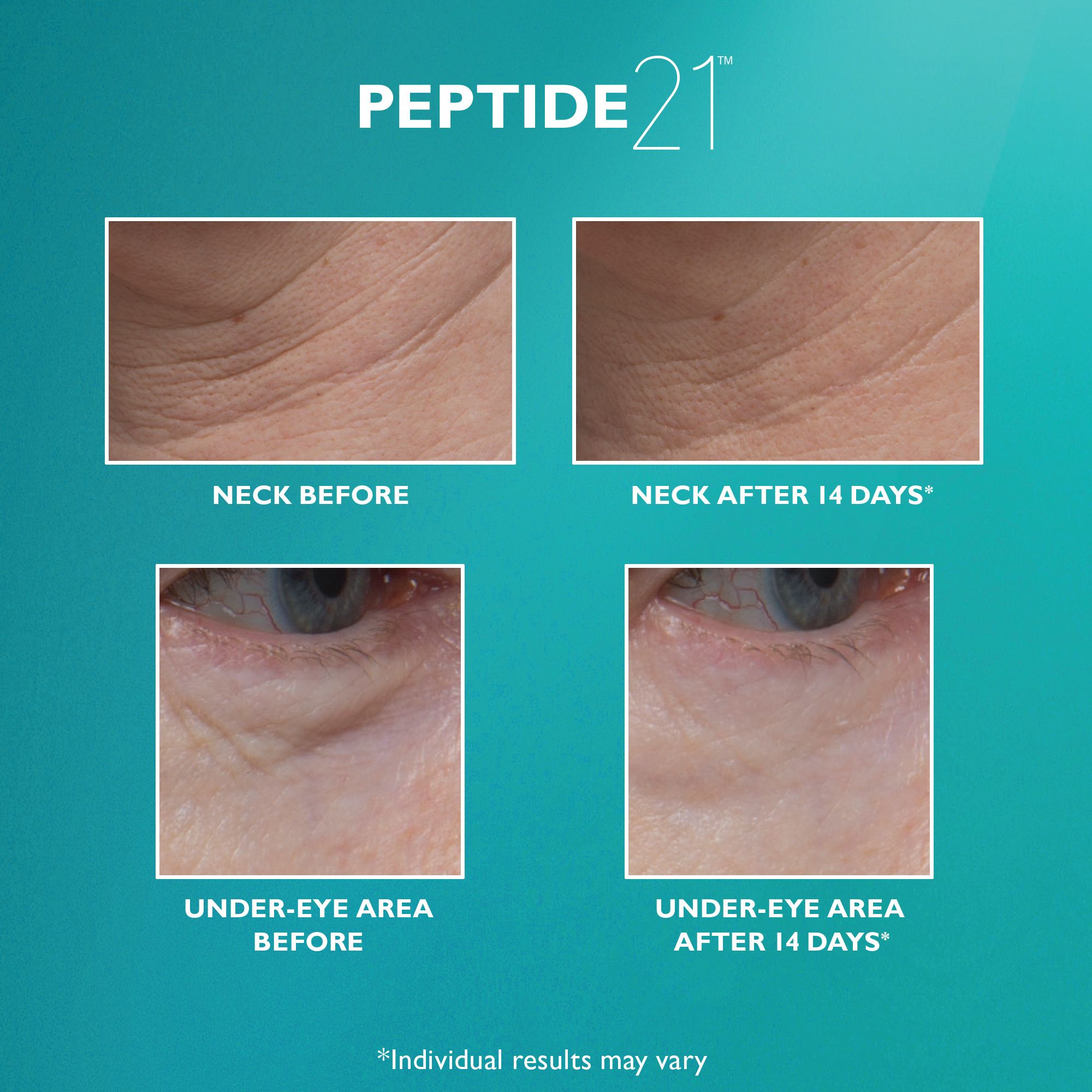 Vorher-Nachher-Bilder von Hals und Augenpartie. Text: PEPTIDE 21.