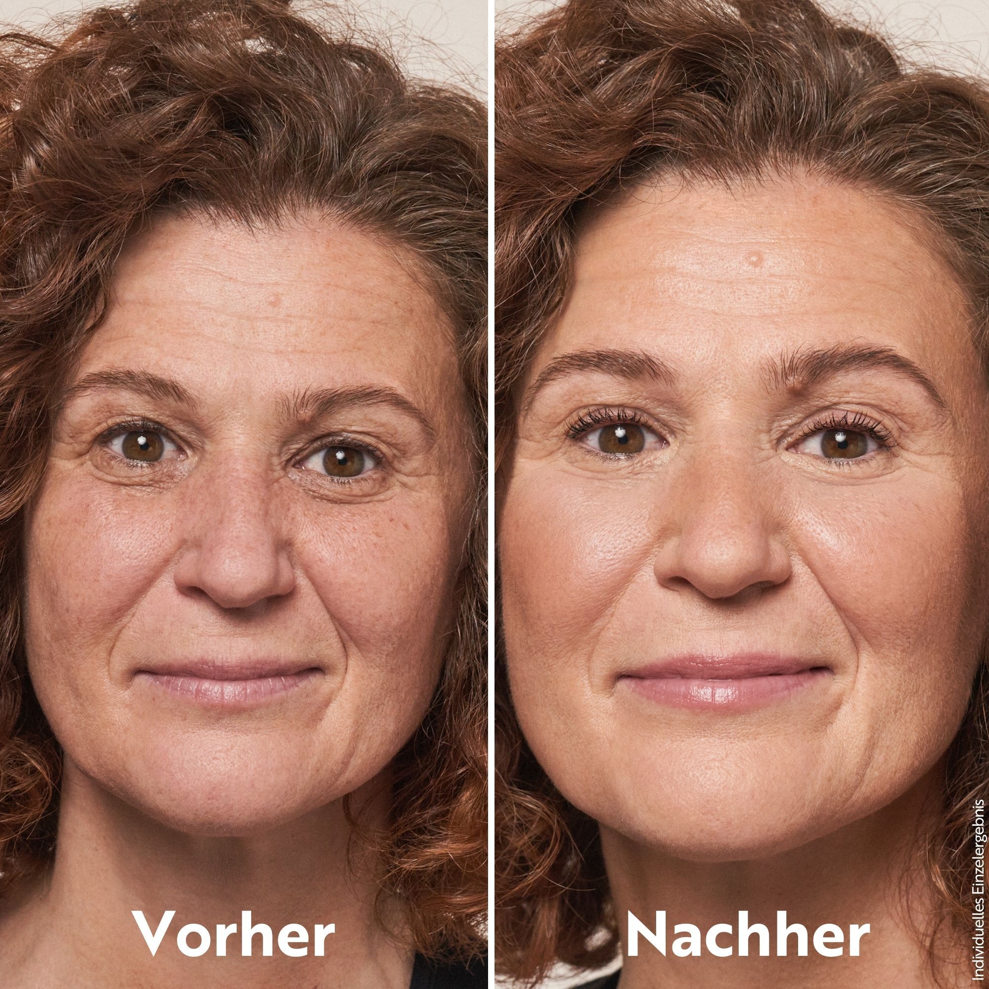 Vorher-Nachher-Vergleich. Frau mit Hautunreinheiten, dann mit ebenmäßigem Teint. Text: Vorher, Nachher. Individuelle Ergebnisse.