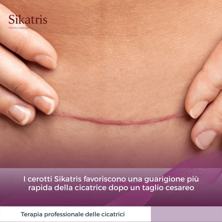 Nahaufnahme eines Bauches mit einer Narbe. Text: 'I cerotti Sikatris favoriscono una guarigione più rapida della cicatrice dopo un taglio cesareo'.